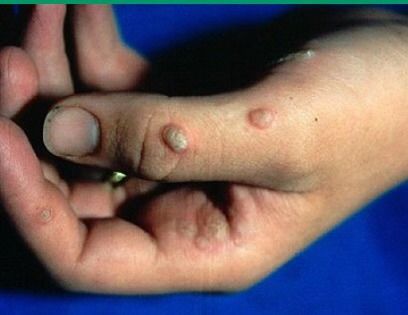 皮肤科医生告诉你:如何分辨身上的这些「小疙瘩」|鸡眼|皮肤科_新浪新