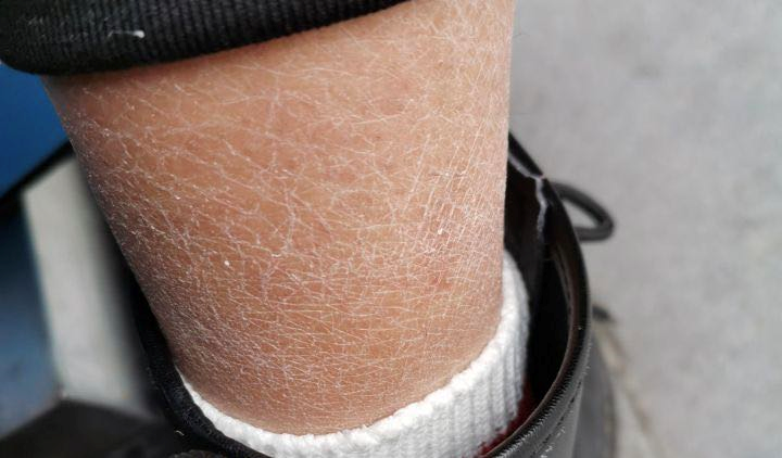 鸡皮肤吃中药可以治好嘛(鸡皮肤吃中药可以治好嘛女性) 鸡皮肤吃中药可以治好嘛(鸡皮肤吃中药可以治好嘛女性)