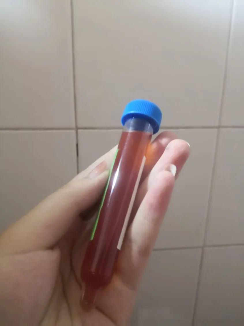 做尿检 | 作者供图尿检和ct结果很快就出来了,尿液中的红细胞是正常值