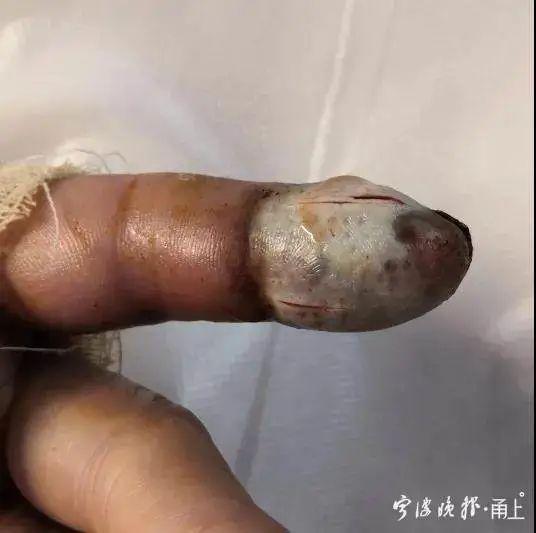 医生提醒:与它遭遇时千万别这样做