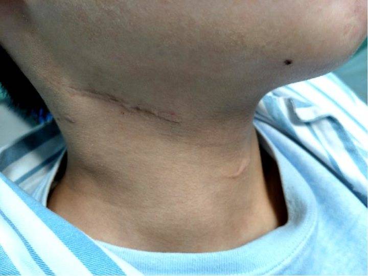 儿童甲状腺反复发炎一定要警惕梨状窝瘘