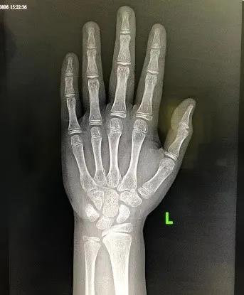 相较于年龄,骨龄更能准确反映出孩子的骨成熟度,是评价儿童生长发育