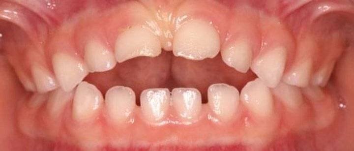 胶东半岛口腔医院:儿童牙齿不齐,除了带牙套,还有第二种选择