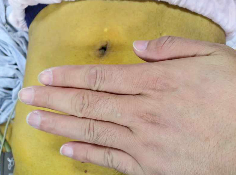 潍坊市中医院东院区解决患者梗阻性黄疸 成功为抗击肿瘤争取时间