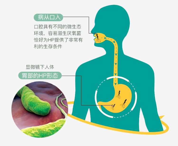 ▲幽门螺杆菌是一种微需氧菌，生长在胃和十二指肠粘膜里，引起粘膜炎症，破坏胃黏膜。诺贝尔医学奖得主发现，在胃部强酸环境下，只有它能够存活下来。