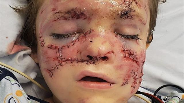 6岁男童遭比特犬疯狂撕咬 鼻骨断裂惨毁容 原因竟是这个?妈妈泪崩