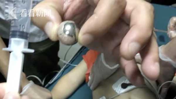 命悬一线！2岁男童吞下钢珠被卡住气管 昏迷2个多小时休闲区蓝鸢梦想 - Www.slyday.coM