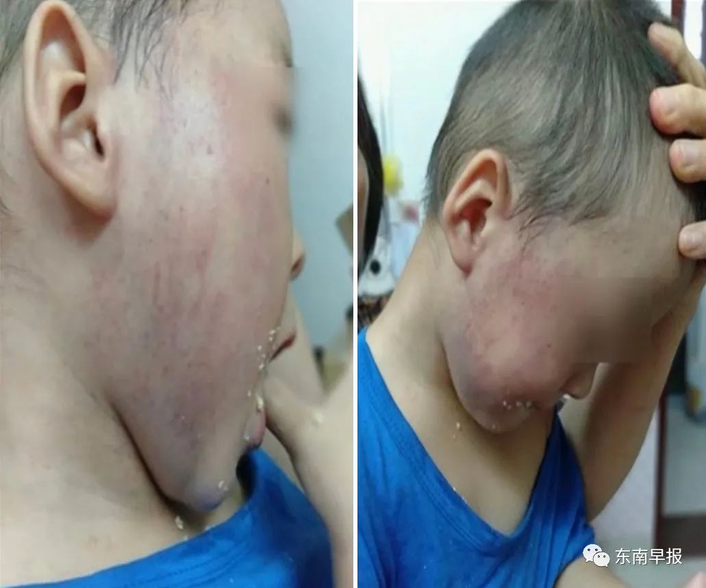 2岁男童右脸被打肿,19岁女老师被开除|幼托|女士|好孩子_新浪新闻