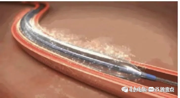 新泰市人民医院心内二科独立完成药物涂层球囊介入治疗喜获成功