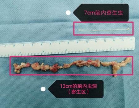 边背诗边开颅捉虫!7厘米虫子寄生脑内7年被"活捉"