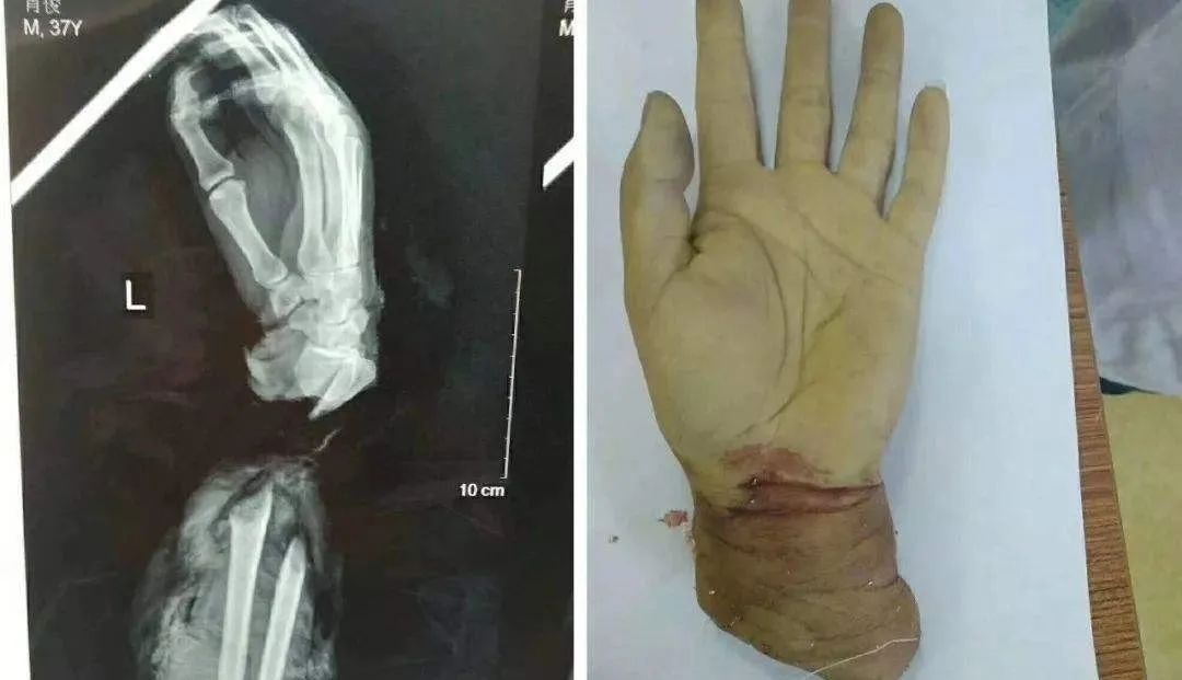 是个狠人!22岁姑娘锯断手骗保