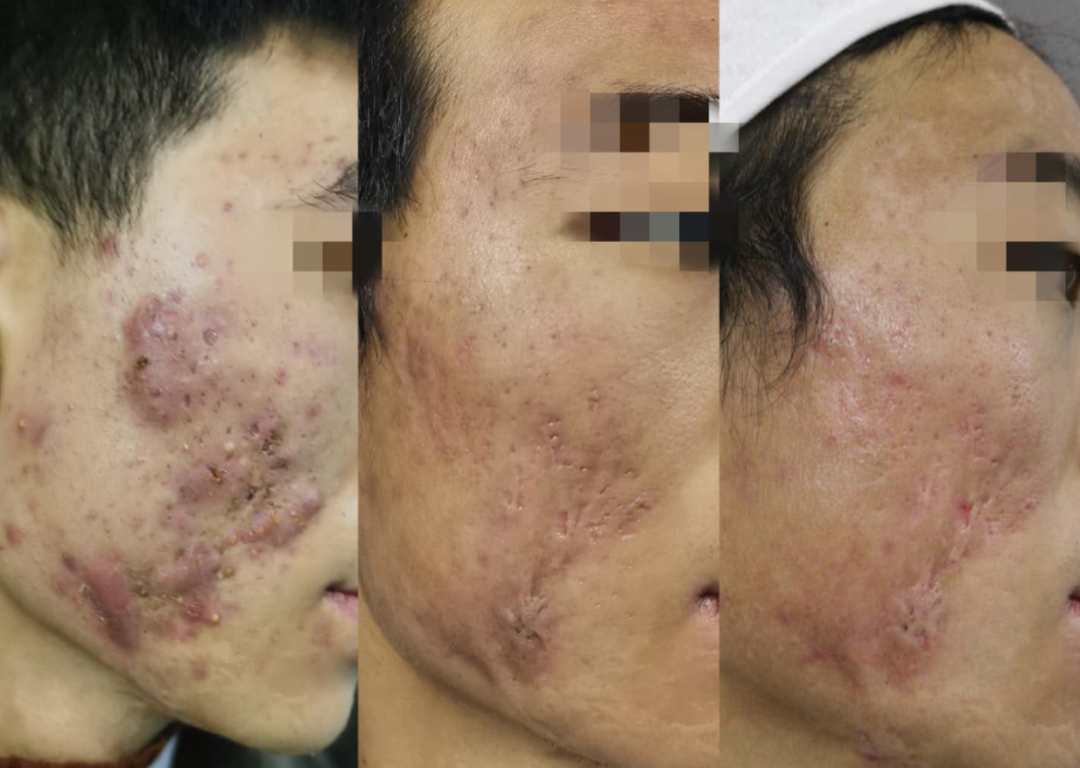 67广东帮扶医生出手,成功修复18岁小伙的"月球脸"