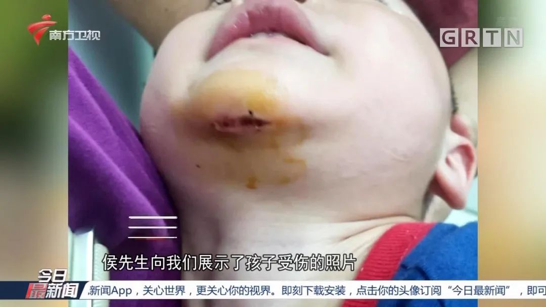 3岁小孩在幼儿园受伤，伤口深达肌肉层！老师称是不慎摔伤，家长看完视频气炸！休闲区蓝鸢梦想 - Www.slyday.coM