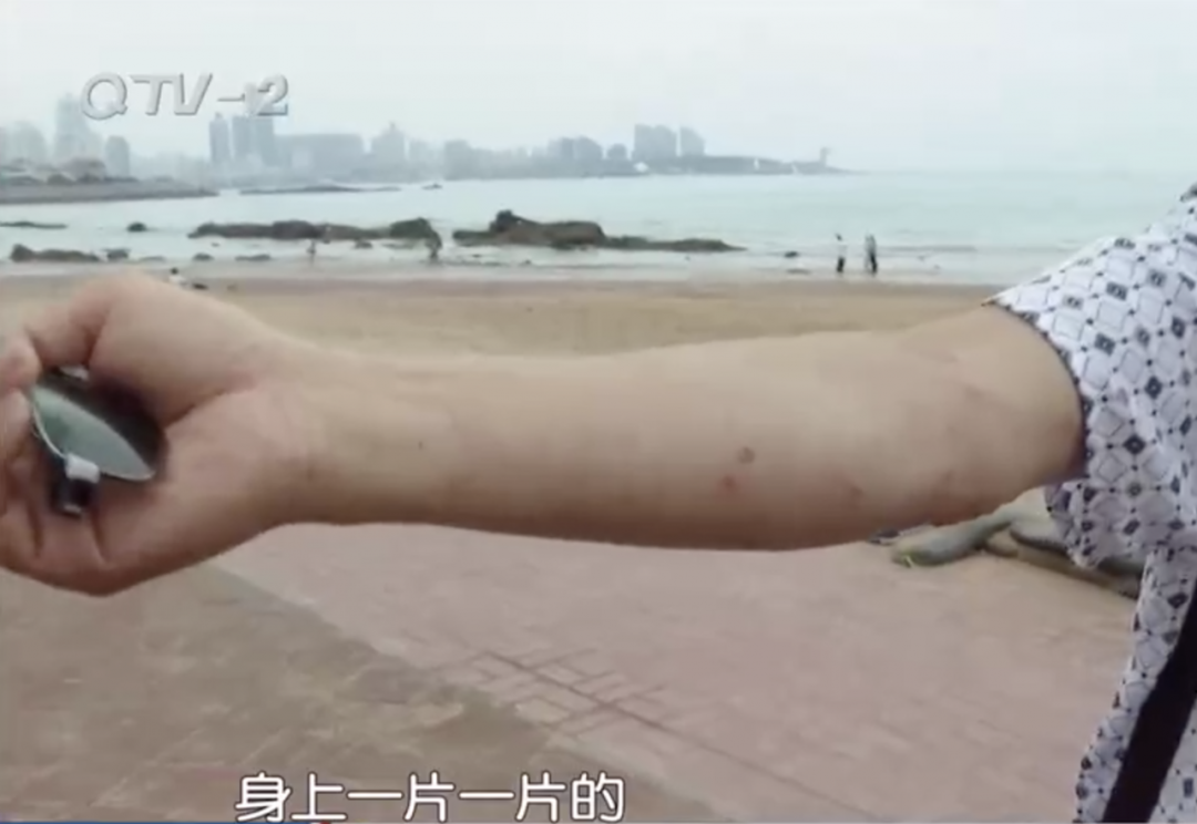 注意市民在青岛三浴游了一次泳胳膊被咬得红肿生疹子