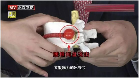 40岁后超过一半的人有椎间盘膨出5大伤腰习惯别再做