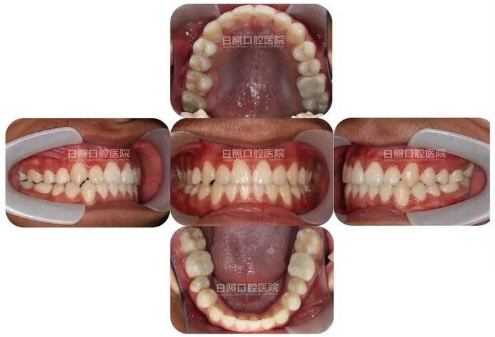 日照口腔医院爱牙课你是否也纳闷是什么造成了牙齿拥挤呢