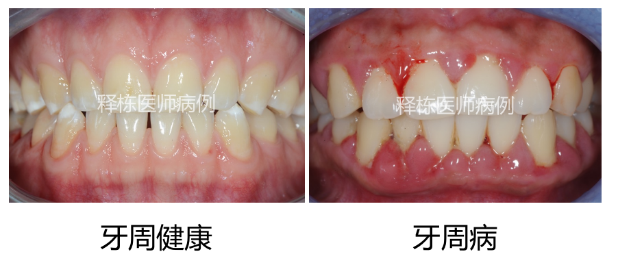 刷牙出血牙齦腫痛為什麼比牙疼更危險