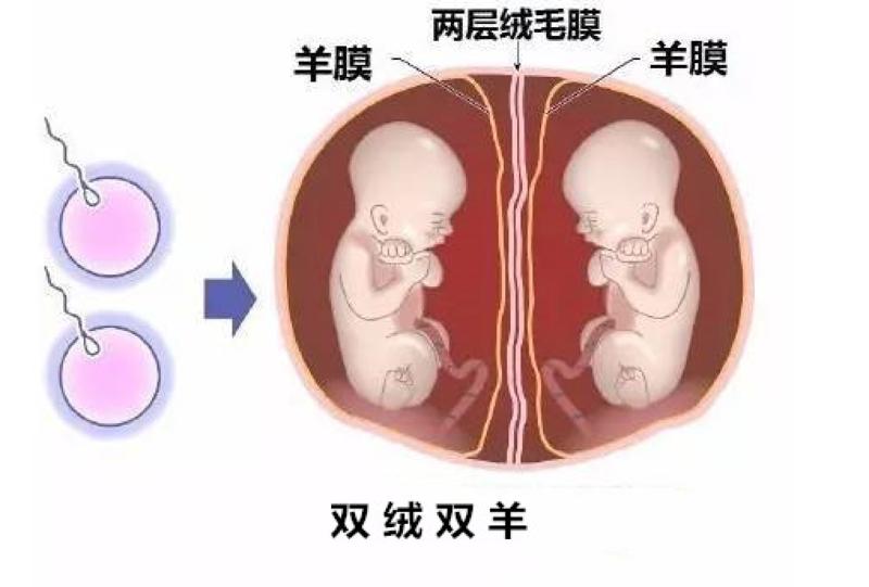 仨宝宝两个胎盘危险重重专家团队护航三胞胎平安出生