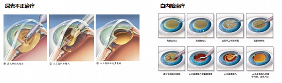 ▲屈光不正&白内障治疗流程简图