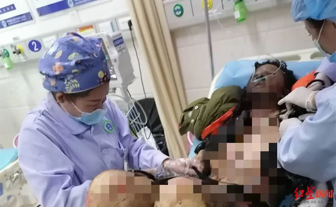 网红拉姆直播时被前夫纵火焚烧烧伤90最新情况恶化直播两年赚2000一天