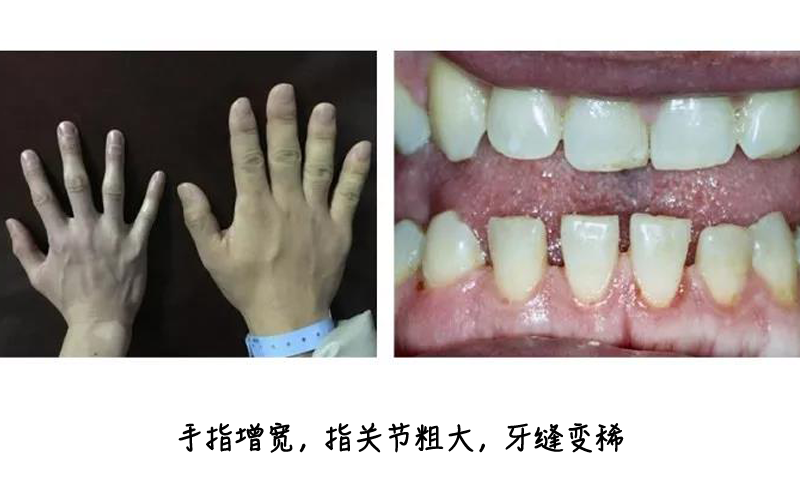 可能是被脑子里这个东西"暗害"了|肢端肥大症|暗害|脑子_新浪新闻