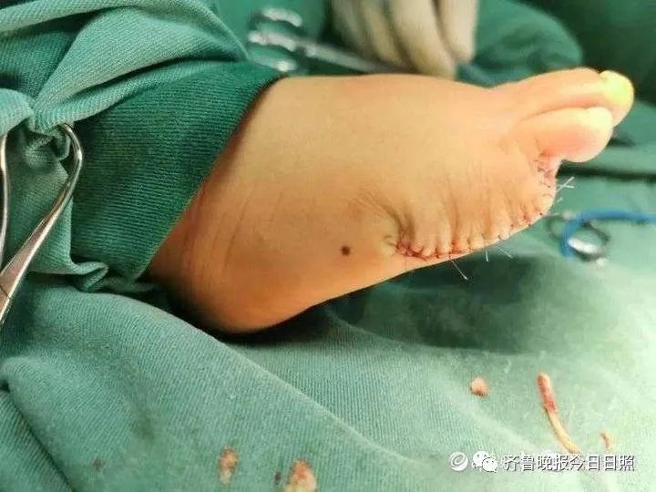"六指宝宝"急坏家人,日照这家医院妙手复原!