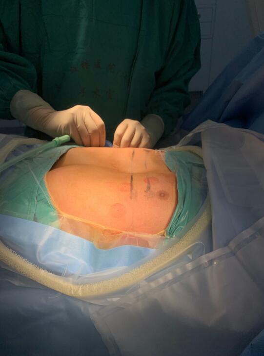 南京鼓楼医院:新型微创nuss手术成为漏斗胸矫形新方法