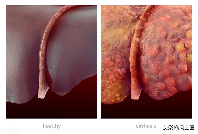 这5个信号是肝脏在求救,若你有至少一个,切勿大意,尽快去医院