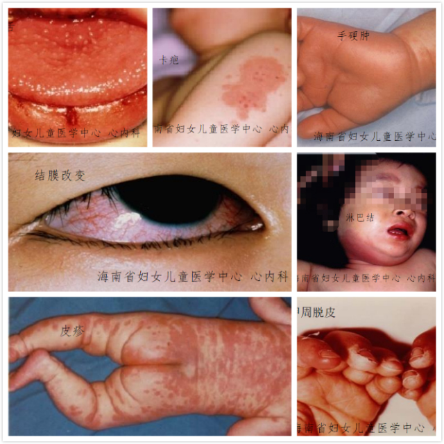 川崎病疹子图片初期图片