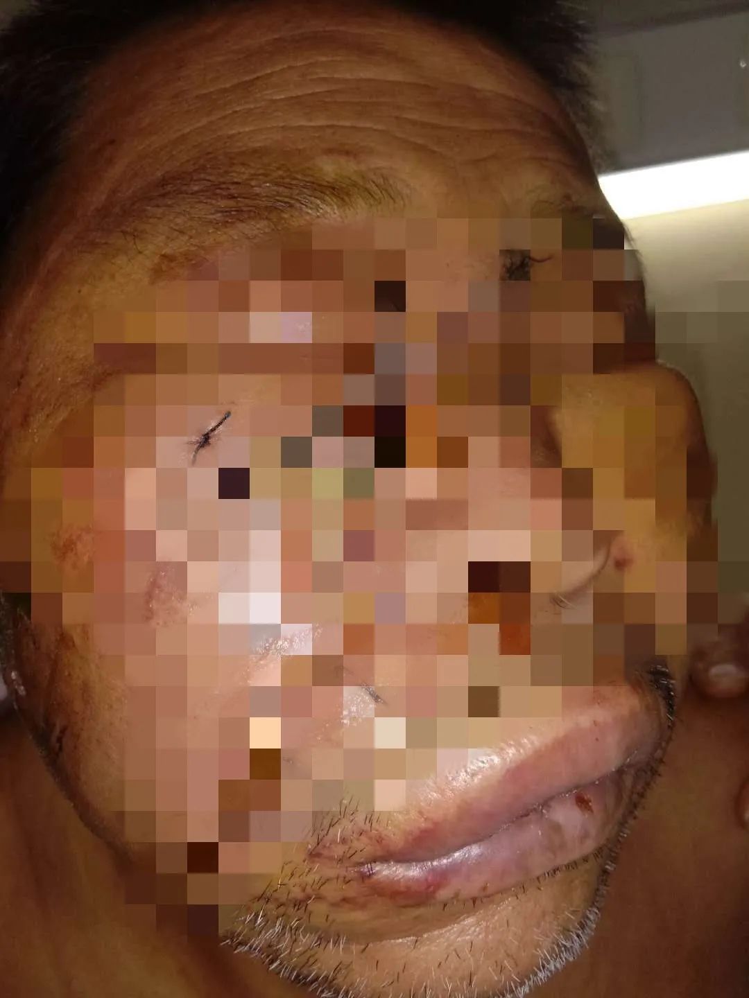 一番撕咬过后,牛光胜已经血肉模糊,脸上大面积组织缺失,身上多处被