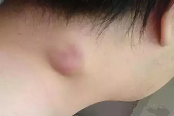 这些小疙瘩暗示肿瘤来临赶紧看看