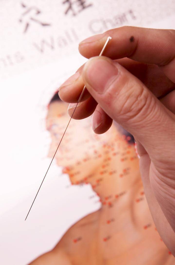 辨证选穴,同时配以董氏奇穴,甩尾挂针法,咬合线挑刺法及梅花针针刺法