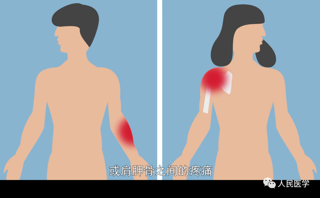 早期肺癌肩痛位置图图片