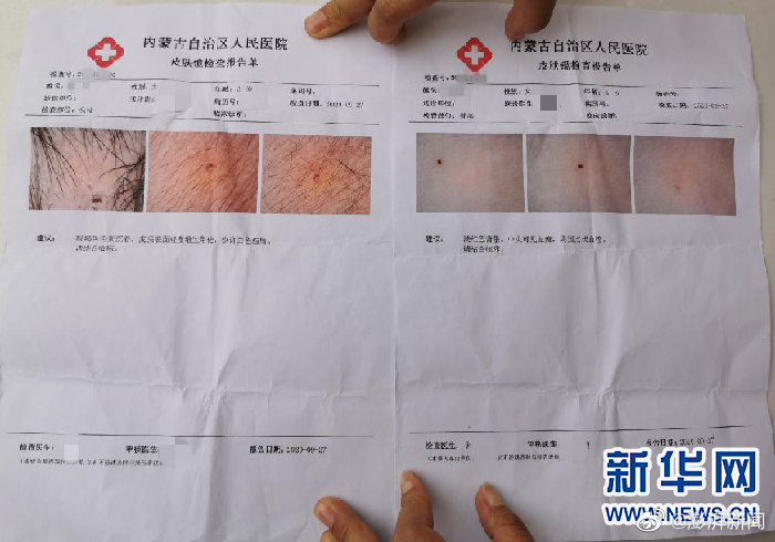 网传幼儿针扎照片