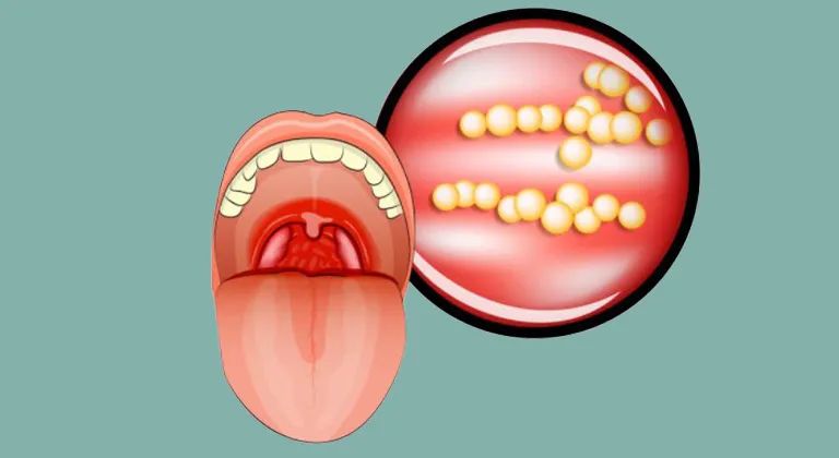 「扁桃体」发炎连累心脏和肾!出现4种变化就该切除了|扁桃体炎|新冠肺
