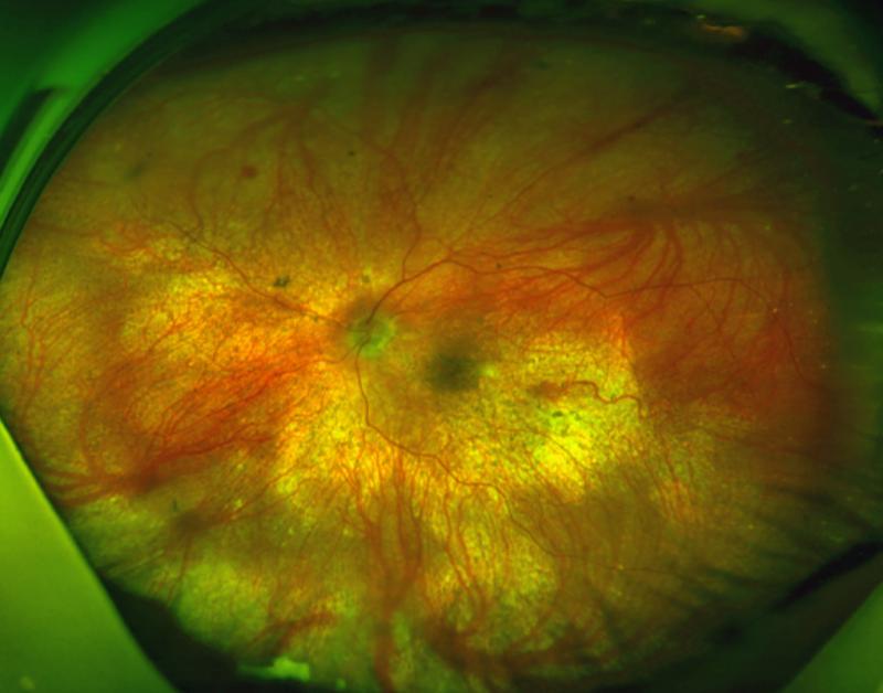 广州阿伯患特殊眼病险致盲,几番波折挽救视力至0.