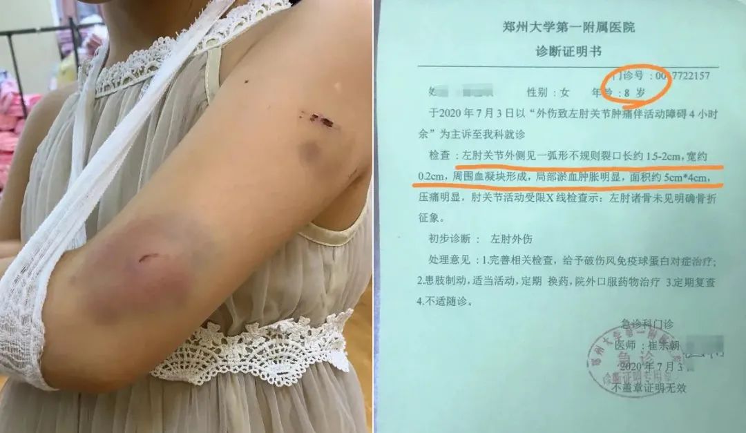 医院开具的诊断证明显示,3岁女童受惊吓后出现抽搐等局灶性癫痫