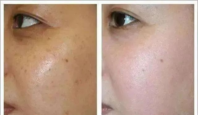 淡斑效果最好的护肤品 美白祛斑多久见效