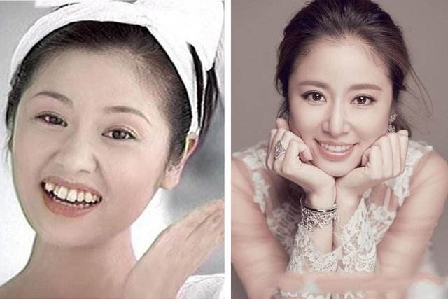 整牙如整容?龅牙男网红晒整牙过程图,3年后卸下牙套秒变许光汉