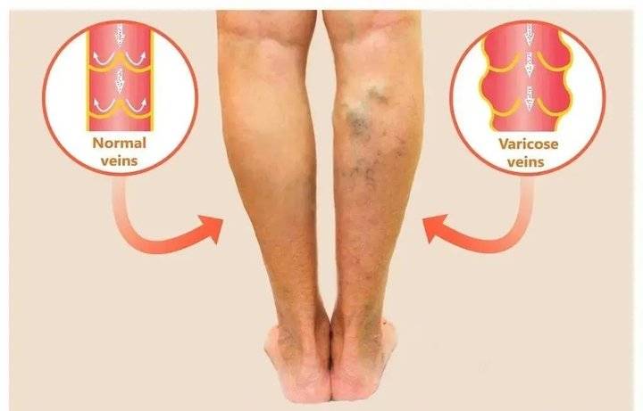 今日热议 得了静脉曲张怎么办 已绝望 静脉曲张 新浪新闻