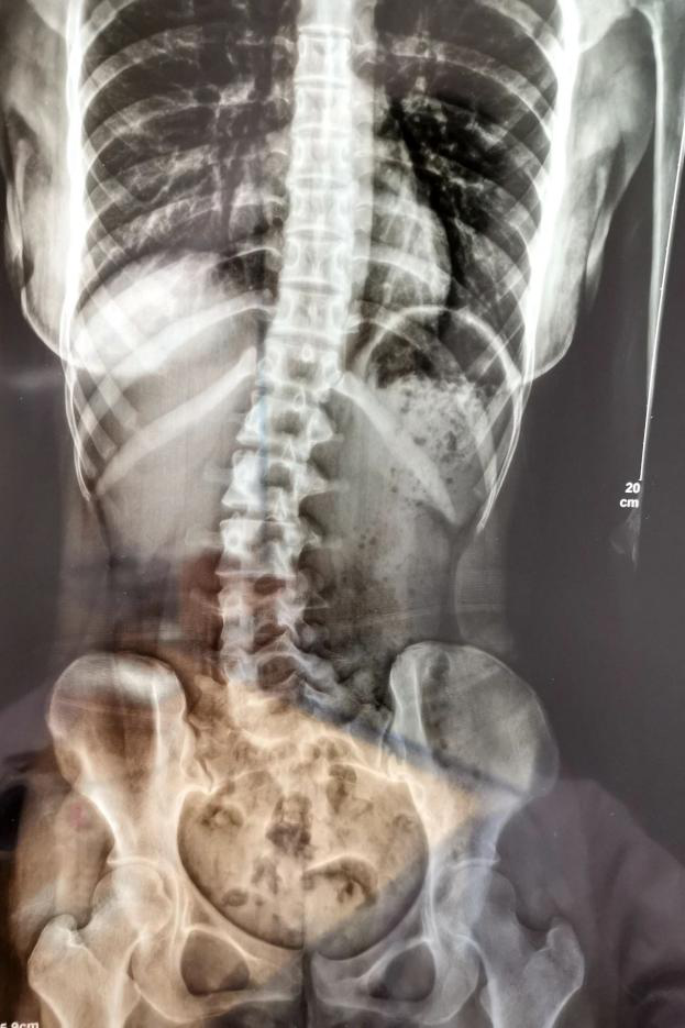 18岁女孩脊柱严重侧弯，元凶竟是……你可能也做过！休闲区蓝鸢梦想 - Www.slyday.coM