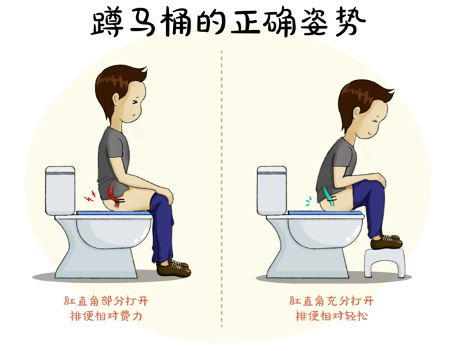 所以首选蹲位姿势排便,如坐位排便可选择借助脚蹬打开肛直角,所谓"