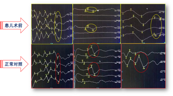 此外,对锐锐的电生理检查结果显示,孩子的脑电波波形很低,比之正常人