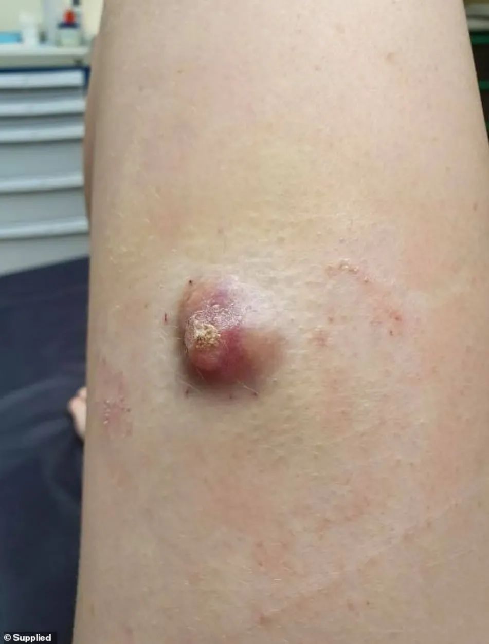 女孩腿上长包医生说没事,一年后再检查:癌症晚期!