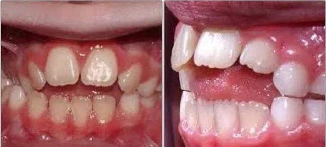 儿童吮指,千万不能忽视|牙齿_新浪新闻