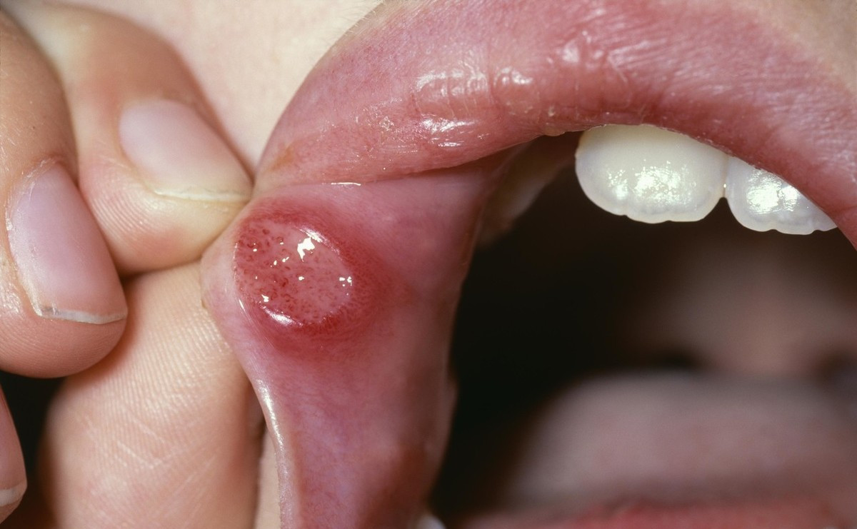 有一种痛叫口腔溃疡医生5个办法减少溃疡疼促进愈合