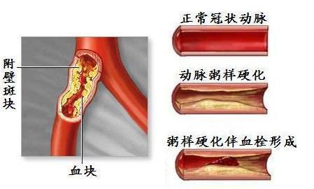 仅仅是因为"遗传父母"吗?|脑血栓|血栓|血管_新浪新闻