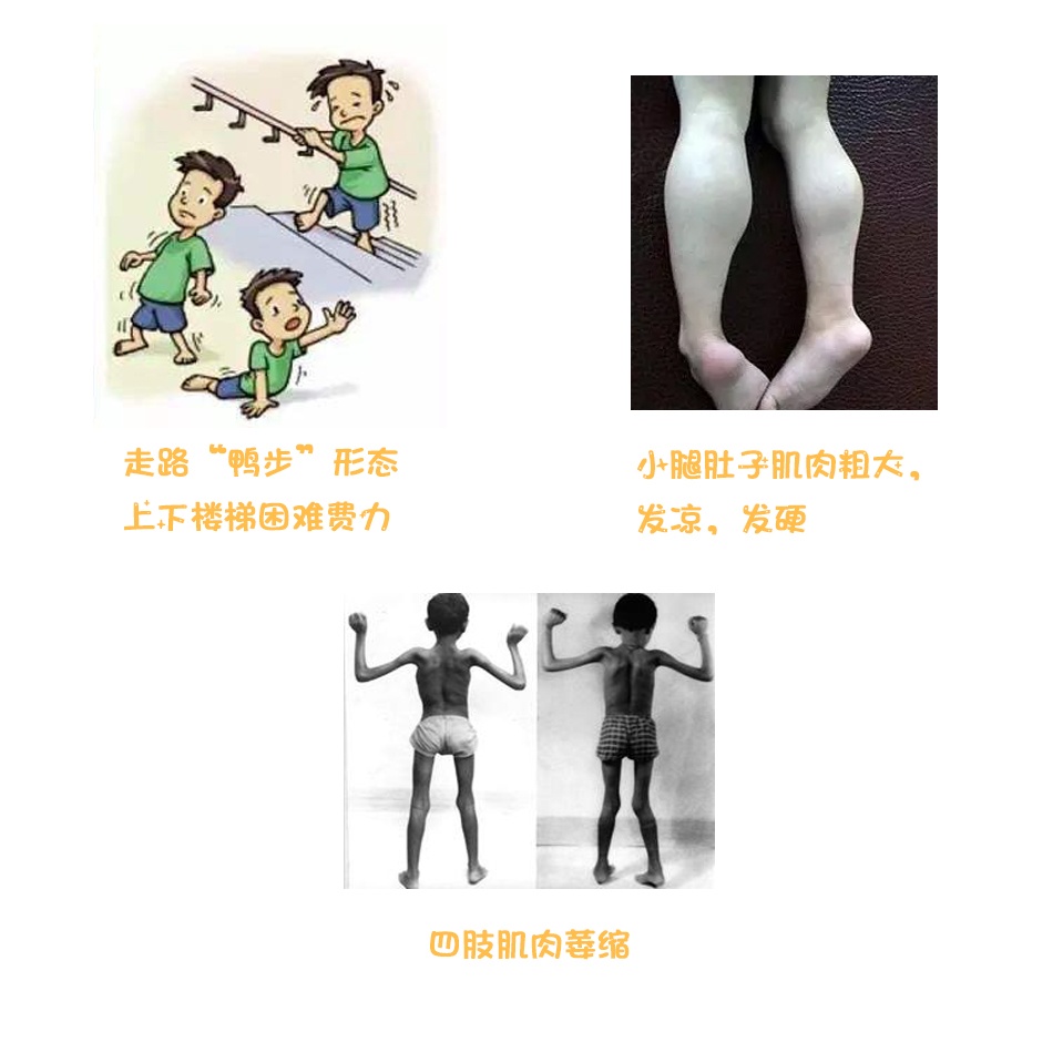 肌酸激酶在我们人体的作用主要存在与骨骼肌当中,肌肉如果破坏特别