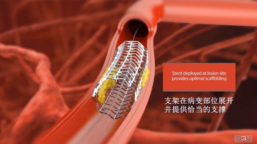 降价后冠脉支架已在23省市区落地，3D动画了解心脏冠状动脉支架植入术_新浪新闻
