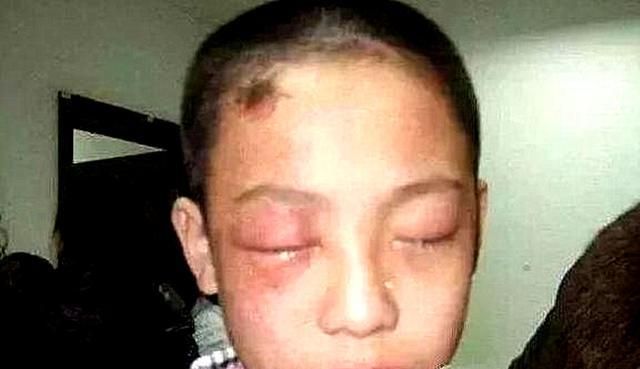 5岁男娃眼睛被溶,几乎失明!这样的"玩具",家长别让孩子碰